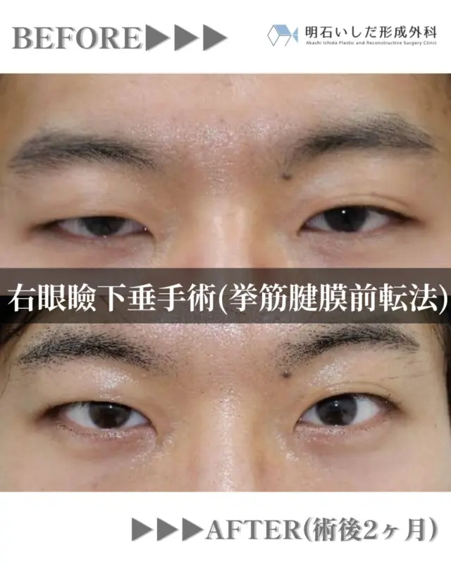 🌸
こんばんは、明石いしだ形成外科です⭐️

右先天性眼瞼下垂を疑う方です。
ある程度眼瞼挙筋の機能が残っていたので、右眼瞼下垂症手術（挙筋腱膜前転法）を実施させていただきました。

お写真は術前と術後2ヶ月での状態です。
経過は良好です。

ご自身やご家族にこういったお悩みをお持ちの方はいませんか？
そのお悩み、手術で改善できるかもしれません！
是非一度ご相談下さい✨

⁡
#形成外科 #明石#西新町#明石いしだ形成外科
#眼瞼下垂#脂肪腫#逆睫毛#フットケア#きずあと#ほくろ#フットケア#レーザー#粉瘤#医療脱毛#脱毛#ジェントルマックスプロプラス#シミ取り#ルビーレーザー#ルビートーニング#フラクショナル#医療化粧品#ドクターズコスメ#リビジョン#プラスリストア#ゼオスキン
⁡